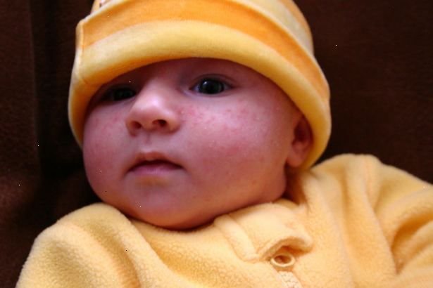 Hvordan man behandler baby acne. Forkæl baby acne helt forskellig fra teenager eller voksen acne.